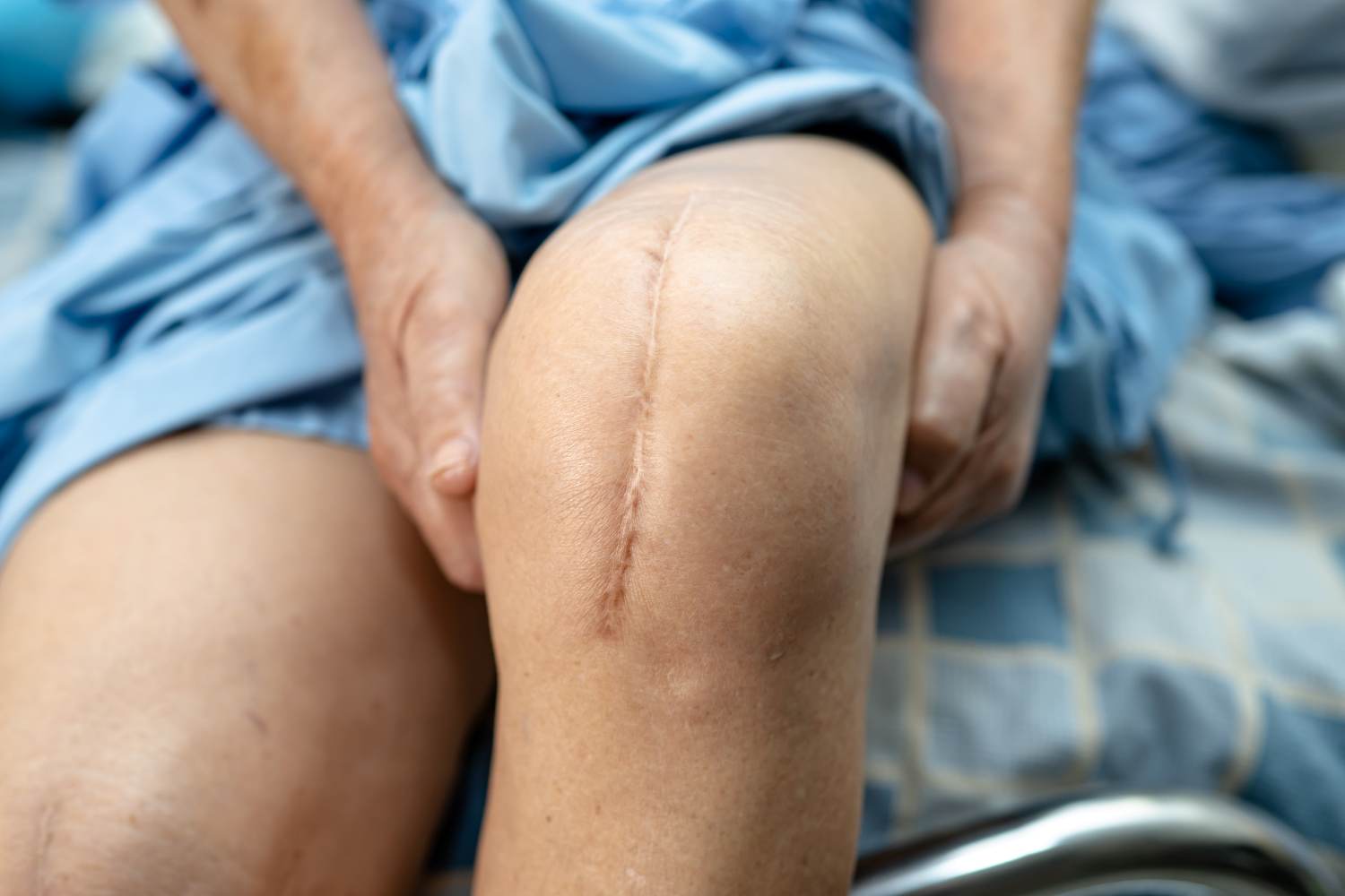 Dalla fisioterapia ai trattamenti medici e chirurgici: ecco come ridurre gli effetti delle cicatrici e migliorare l’estetica e la salute della pelle.