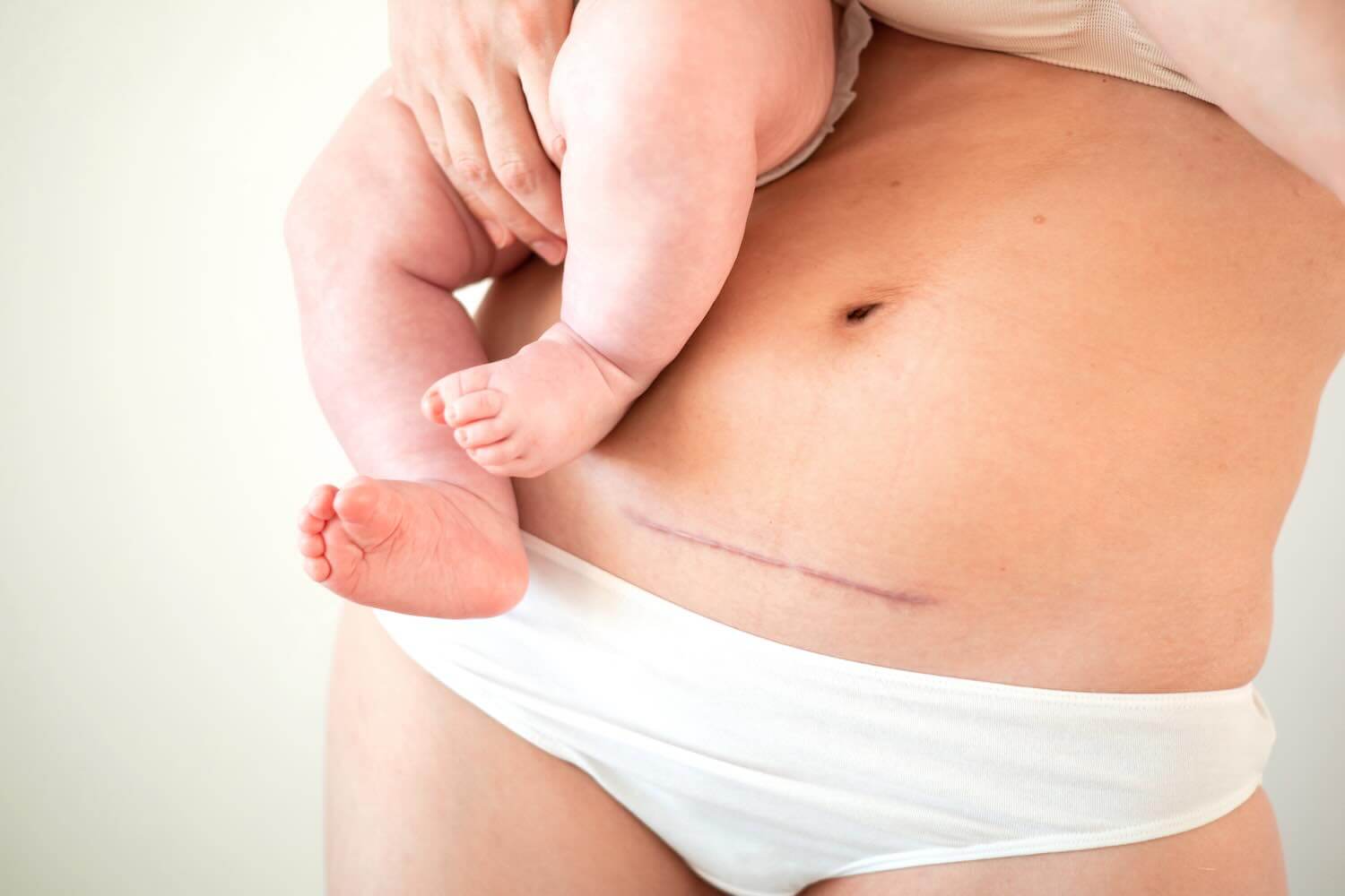 Fisioterapia per la cicatrice da taglio cesareo
